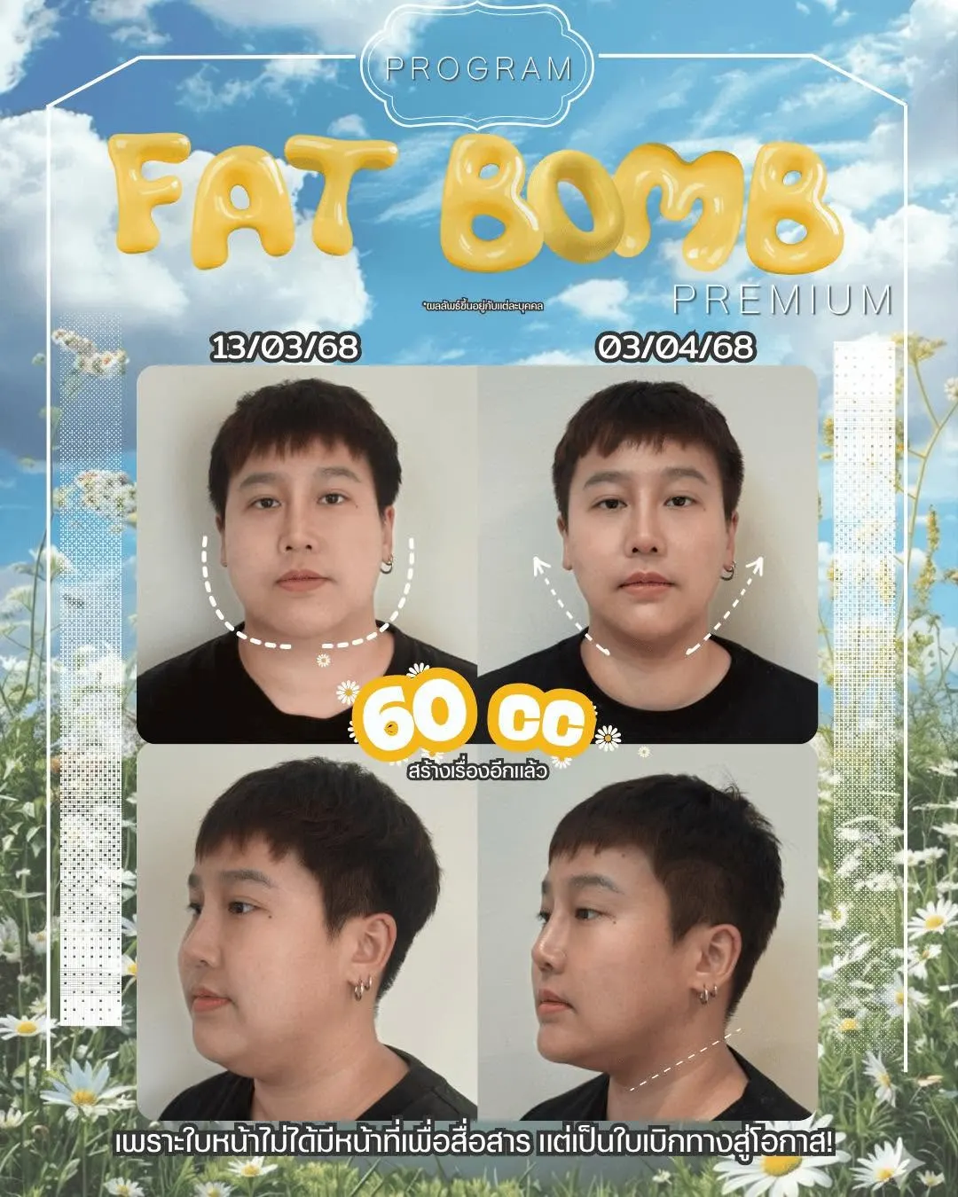 Oppa Skin Clinic คลินิกดูแลผิวและความงาม ย่านอารีย์ ใกล้ BTS อารีย์