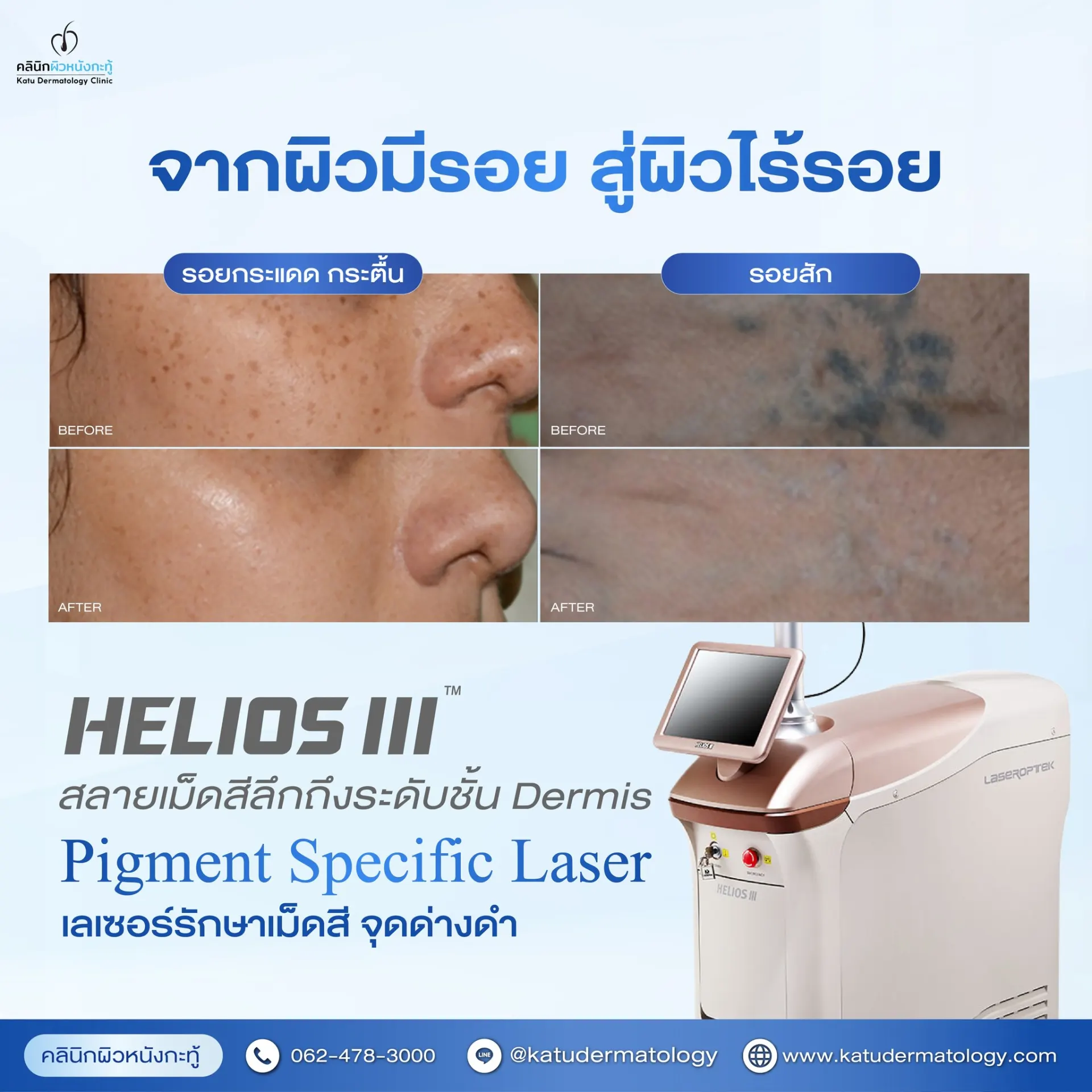 Katu Dermatology Clinic คลินิกผิวหนังกะทู้ ดูแลผิว สิว เลเซอร์ และความงามในภูเก็ต