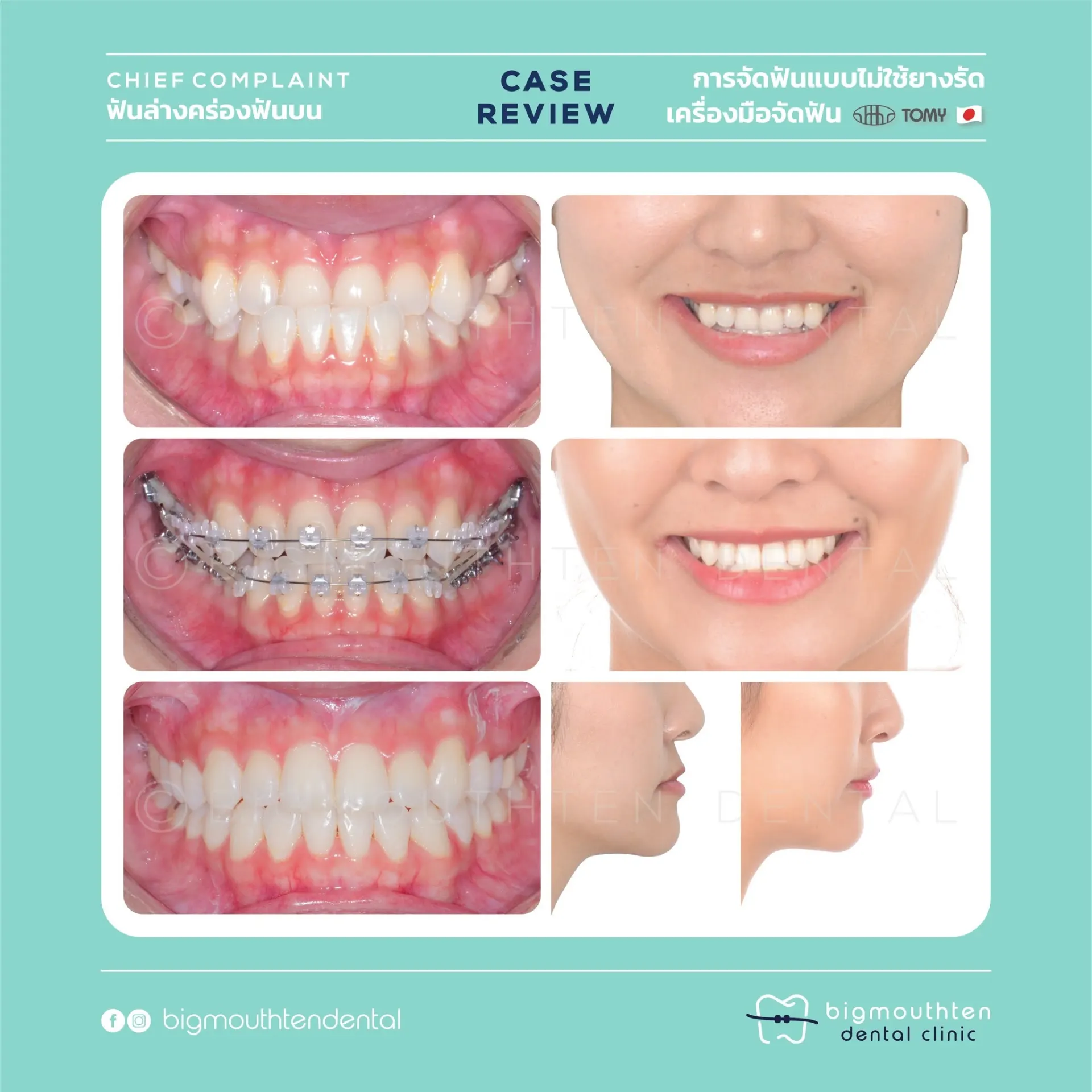 Bigmouthten Dental Clinic คลินิกทันตกรรมเชียงใหม่ จัดฟัน รากฟันเทียม วีเนียร์
