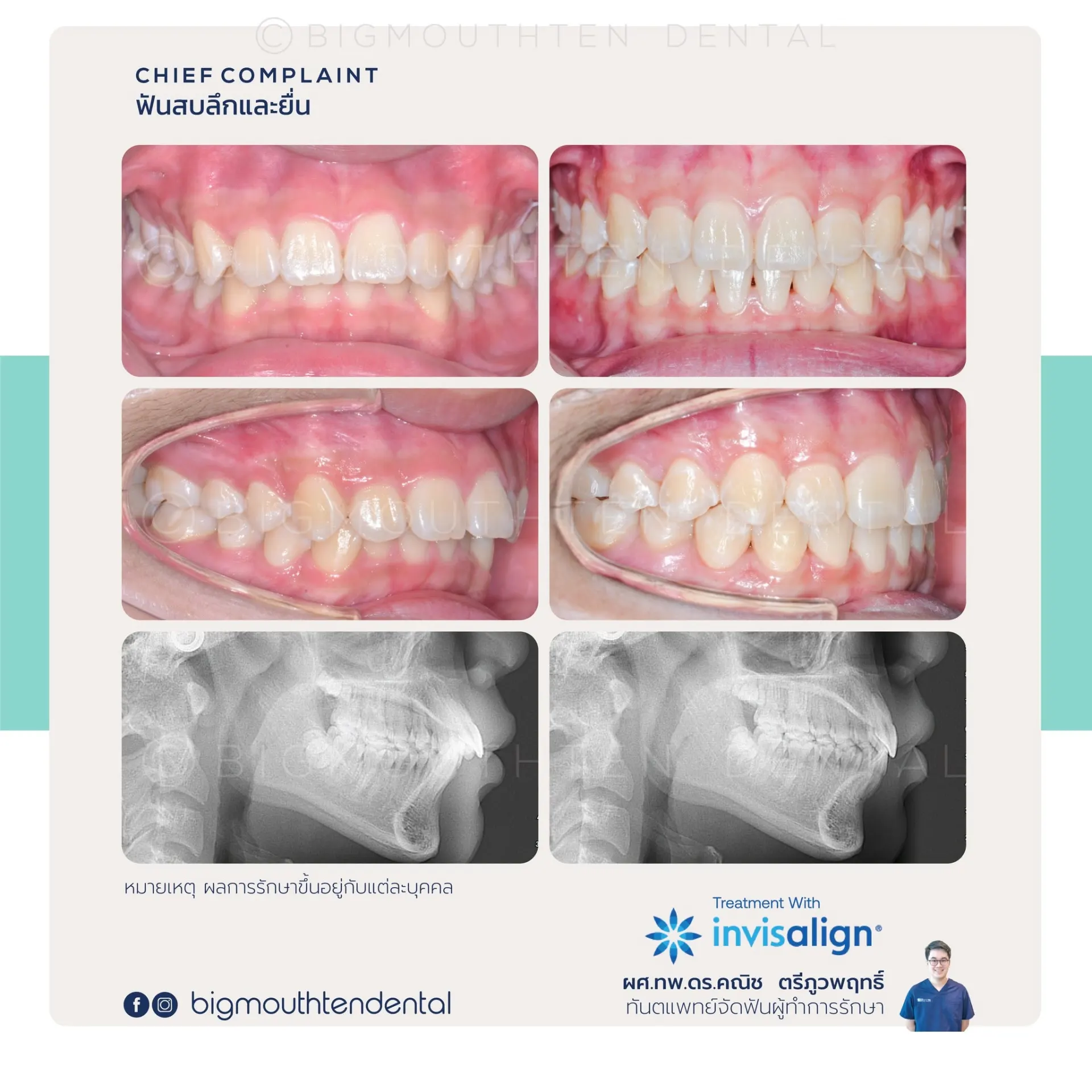 Bigmouthten Dental Clinic คลินิกทันตกรรมเชียงใหม่ จัดฟัน รากฟันเทียม วีเนียร์