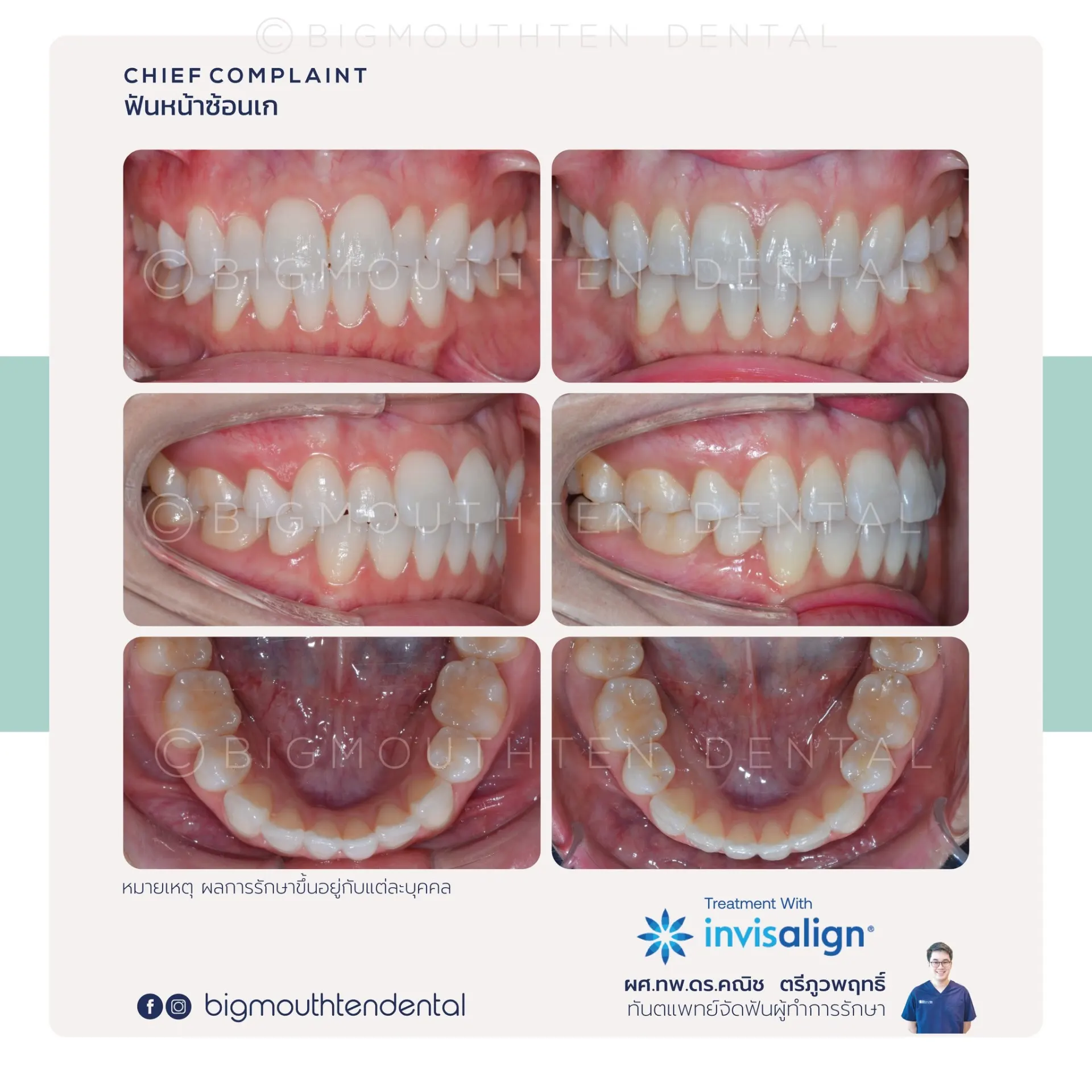 Bigmouthten Dental Clinic คลินิกทันตกรรมเชียงใหม่ จัดฟัน รากฟันเทียม วีเนียร์