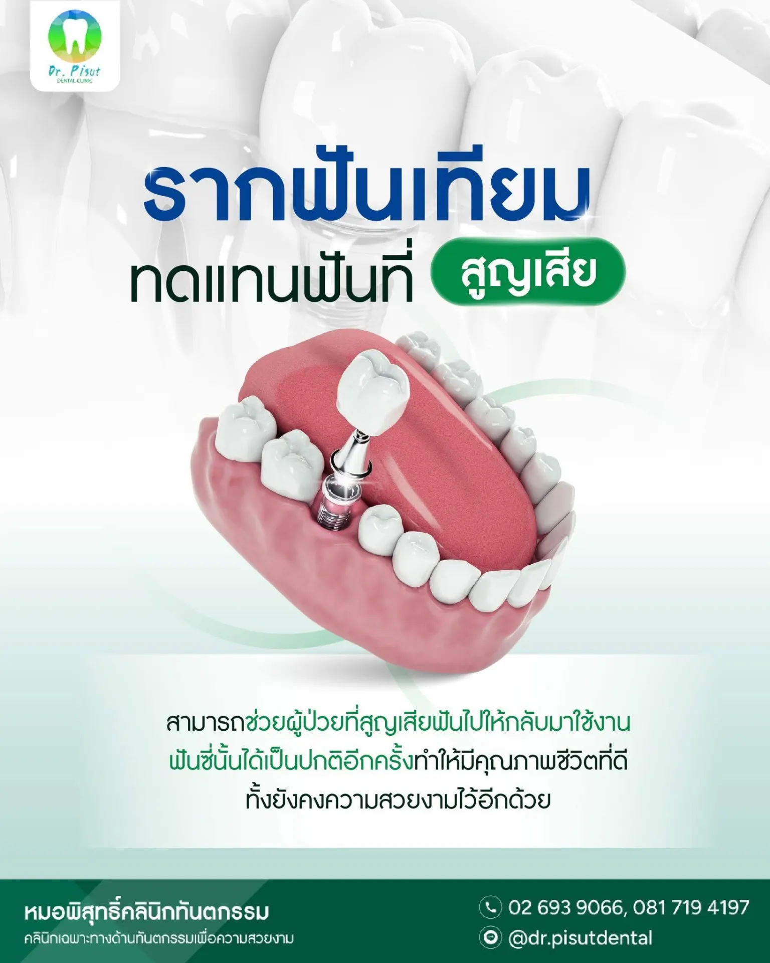 หมอพิสุทธิ์คลินิกทันตกรรม รัชดา บริการรากฟันเทียม จัดฟันใส วีเนียร์
