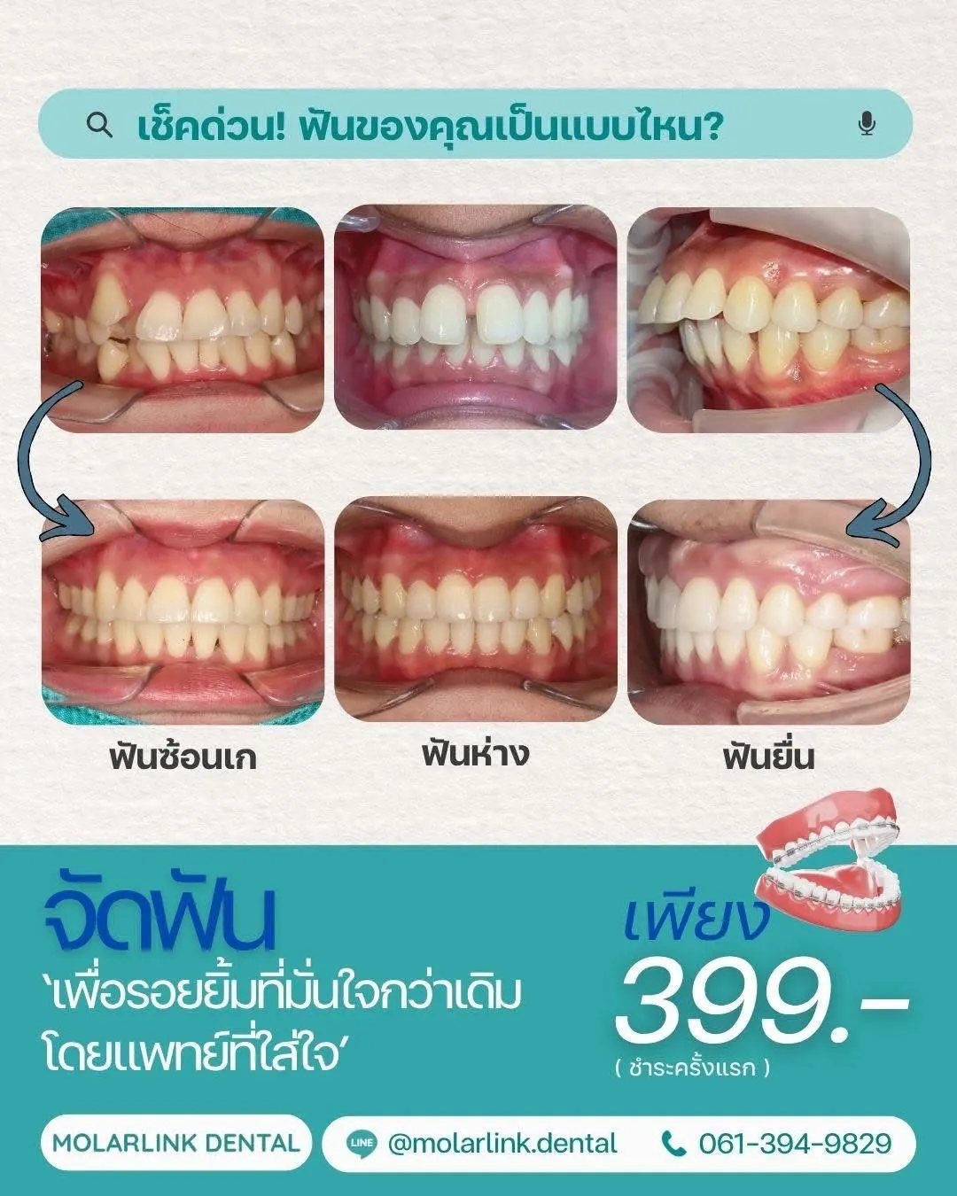 MolarLink Dental คลินิกทันตกรรมโมลาร์ลิงค์ พระราม 2 จัดฟัน รากฟันเทียม วีเนียร์