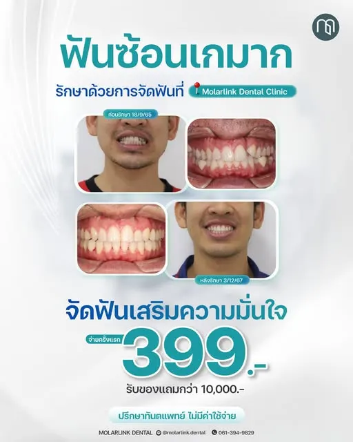 MolarLink Dental คลินิกทันตกรรมโมลาร์ลิงค์ พระราม 2 จัดฟัน รากฟันเทียม วีเนียร์