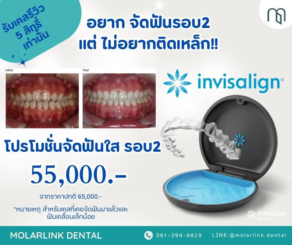 MolarLink Dental คลินิกทันตกรรมโมลาร์ลิงค์ พระราม 2 จัดฟัน รากฟันเทียม วีเนียร์